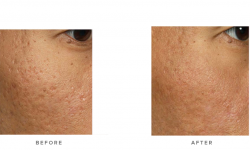 acne scarring laser treatment before and after - patient 001 - infinity clinic