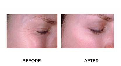 wrinkle relaxers 010 - before and after