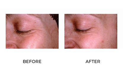 anti-wrinkle injections treatment before and after - image 011 - side view