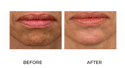anti wrinkle injections 013 - before and after - chin - small image