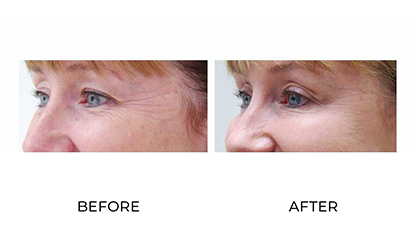 anti wrinkle injections 007 - before & after - side view