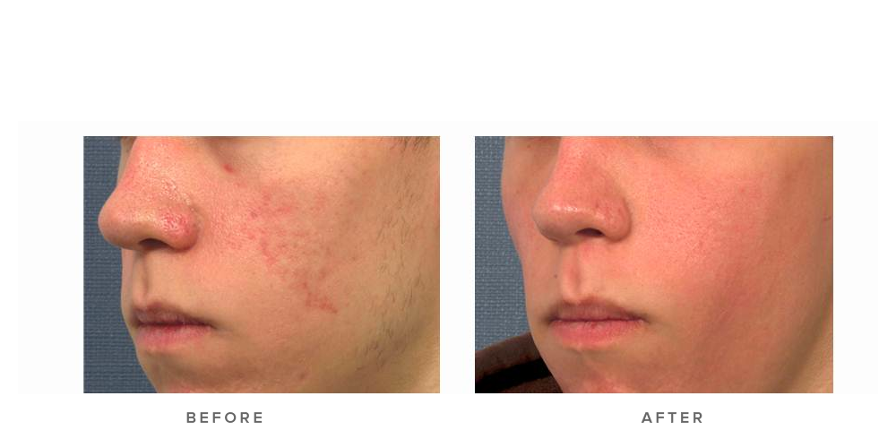 fraxel laser for acne scars - before and after - patient 001 - 45 degree view