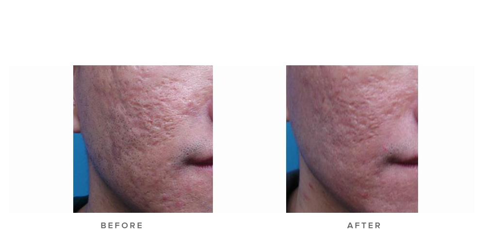 fraxel laser before and after (acne scarring) - before and after 004 - front view