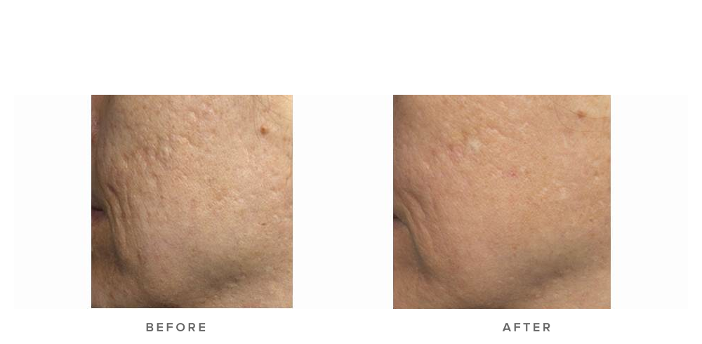 acne scarring treatment with fraxel laser - before and after - image 007