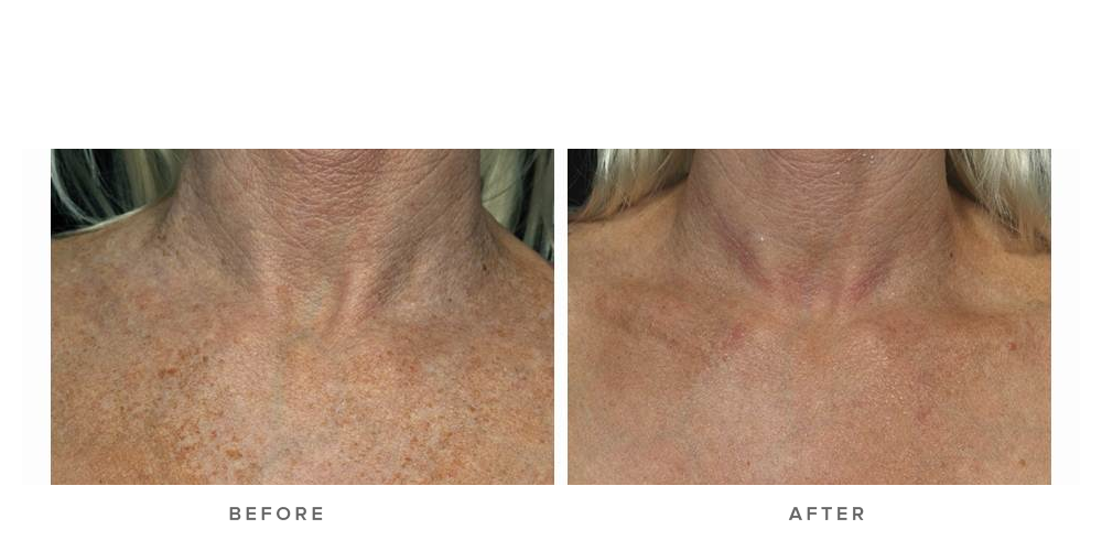 fraxel laser for sun damage and wrinkles - before and after - front