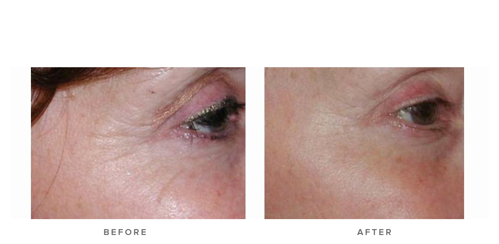 fraxel laser and wrinkles - before and after - side view