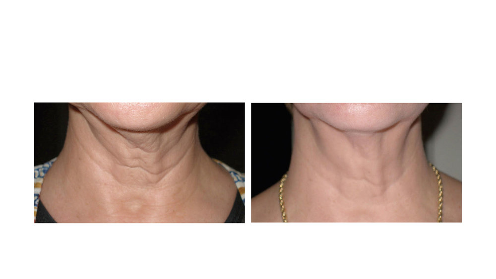 halo laser, forever young bbl, skintyte - before and after 013 - neck