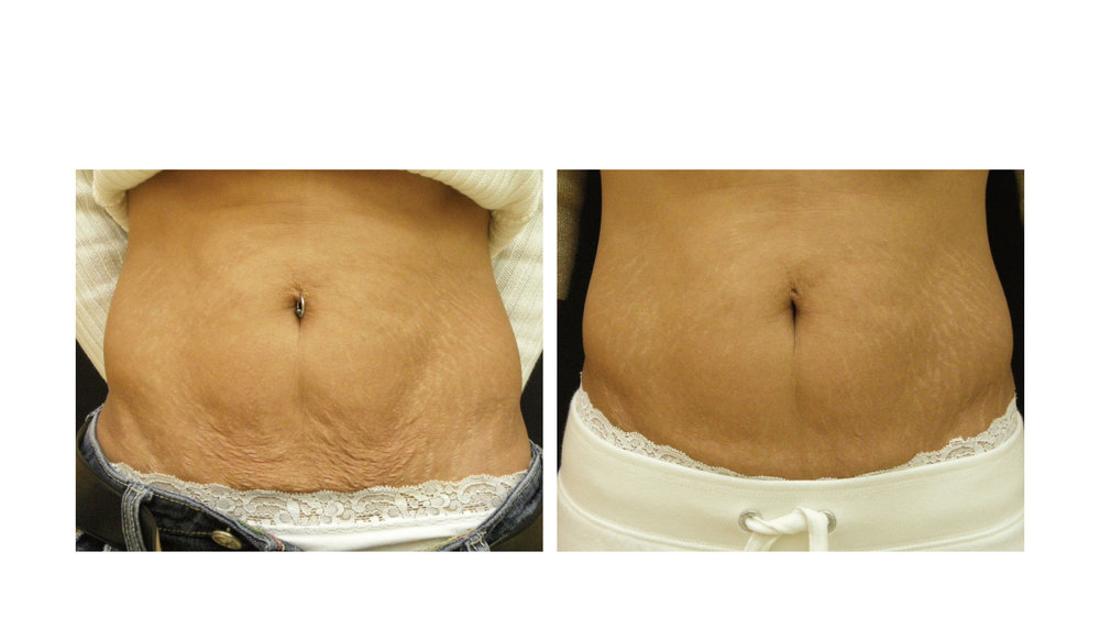 halo laser, forever young bbl, skintyte - before and after 014 - belly