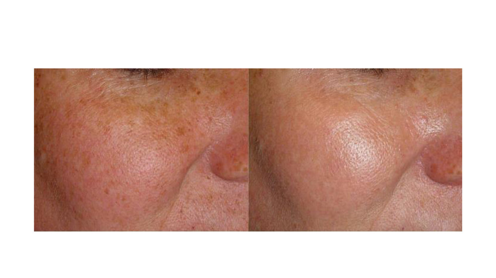 halo laser, forever young bbl, skintyte - before and after 015