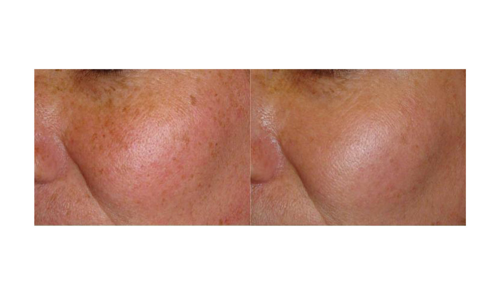 halo laser, forever young bbl, skintyte - before and after 016 - face