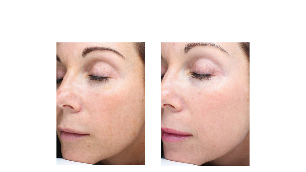 halo laser, forever young bbl, skintyte - before and after 027 - face - 45 degree view
