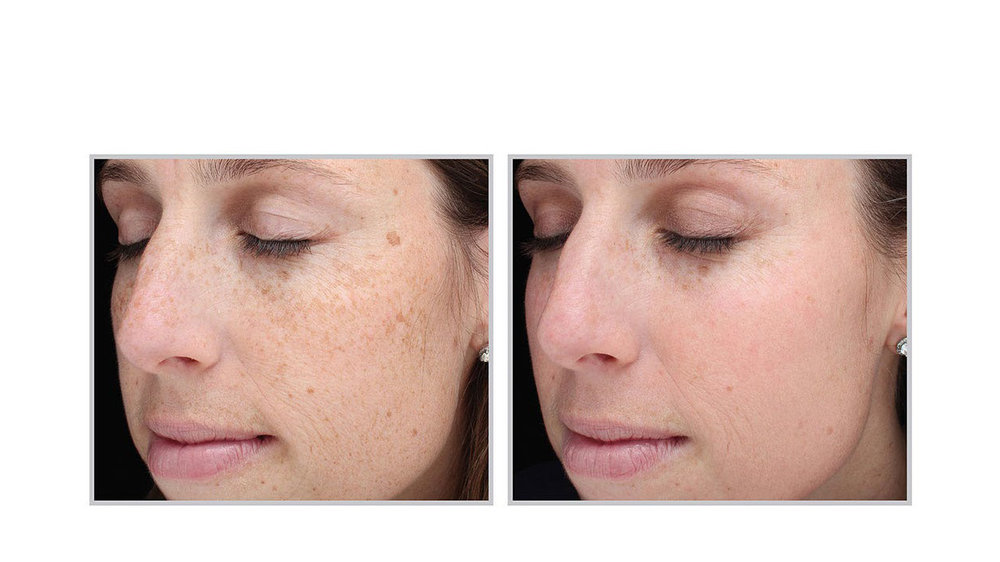 halo laser, forever young bbl, skintyte - before and after 005 - face