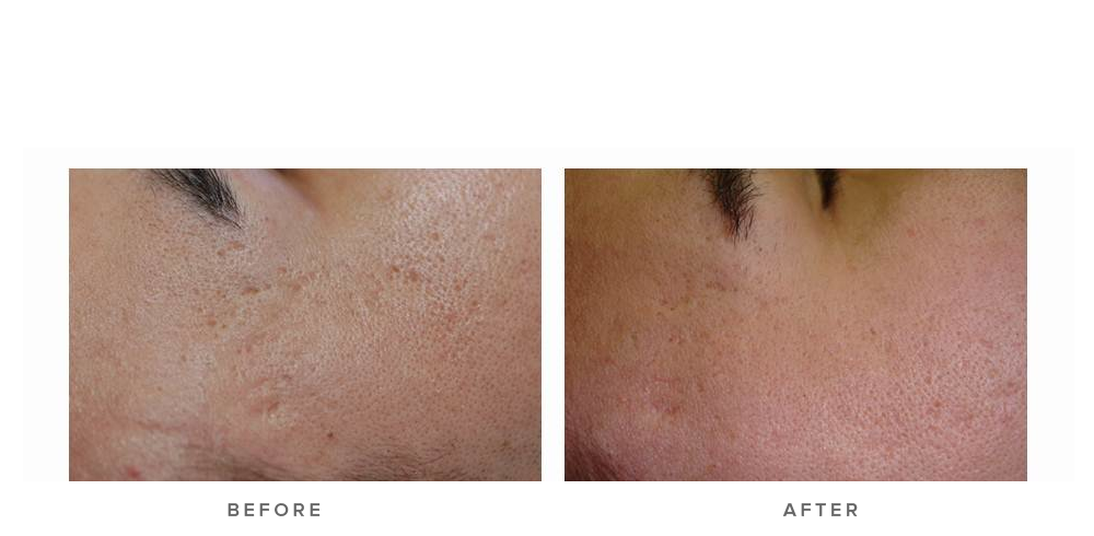 laser genesis treatment for scars - before and after - real patient