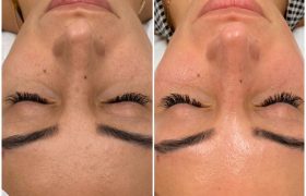 skinpen before and after - image 002