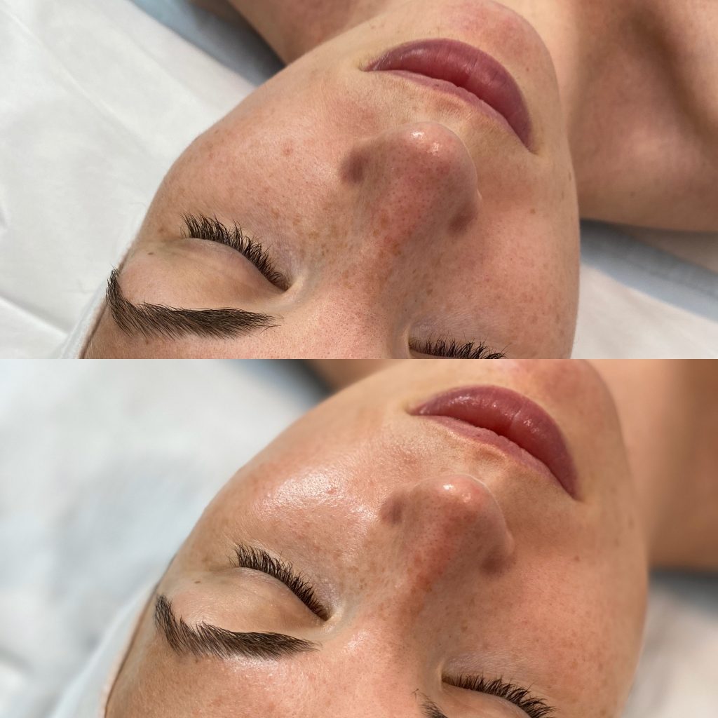 medical grade skin peels - before and after image 002