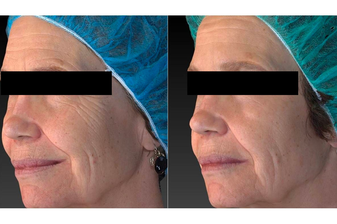 Vivace RF Needling - before and after gallery 002