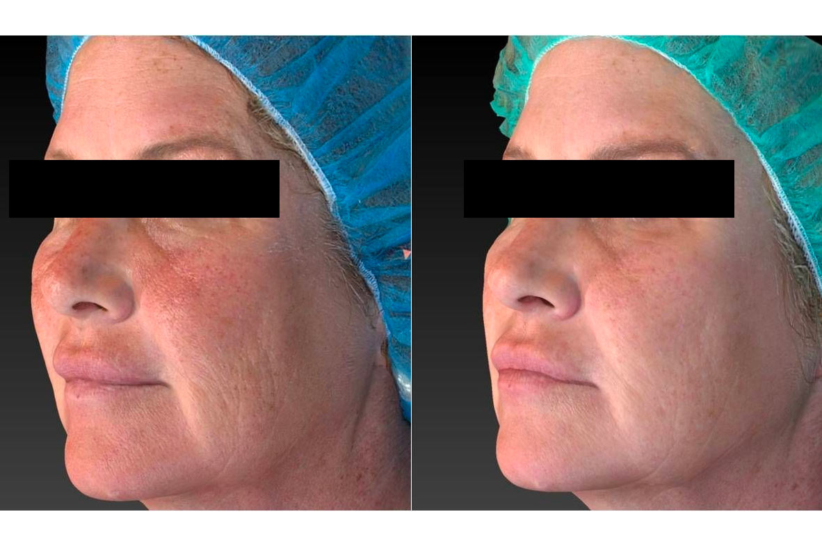 Vivace RF Needling - before and after image 001